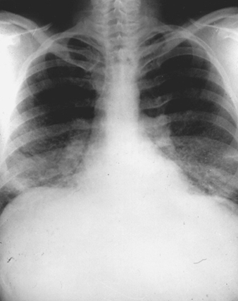 Beryllium lung disease